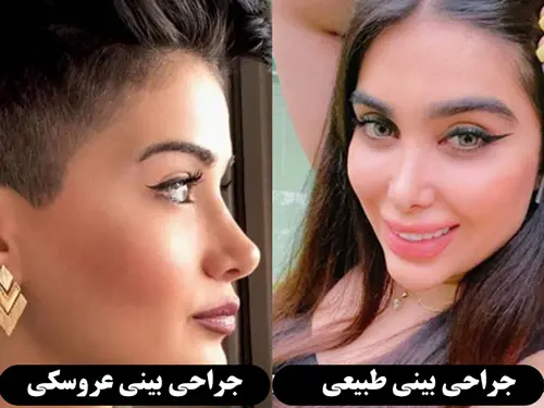عمل بینی عروسکی و طبیعی