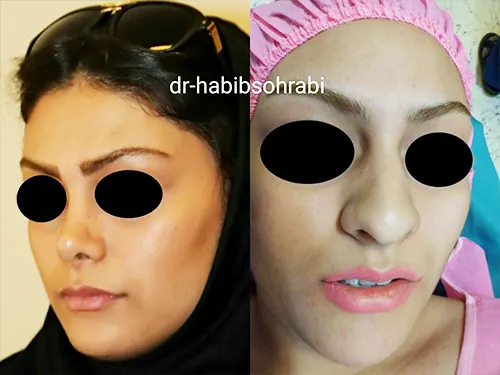 جراحی بینی گوشتی در تهران