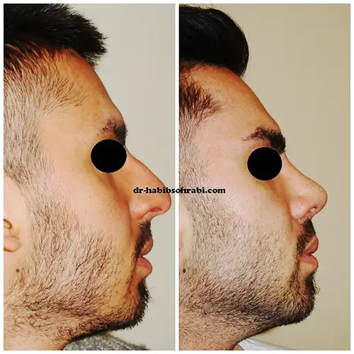 تصویر قبل و بعد بینی استخوانی مردانه