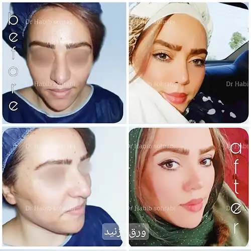 تصویر قبل و بعد بینی استخوانی