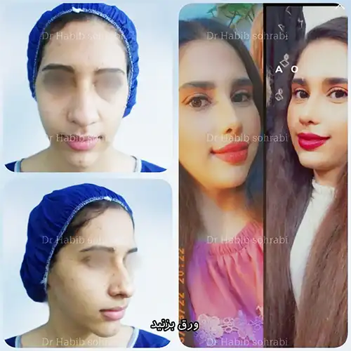 تصویر قبل و بعد بینی استخوانی