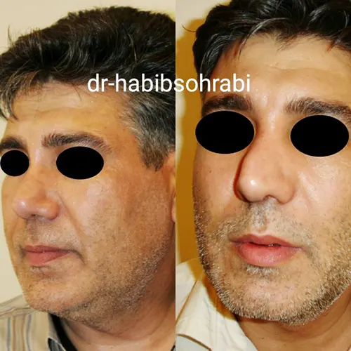 عکس قبل و بعد عمل بینی گوشتی(عمل بینی طبیعی مردانه)