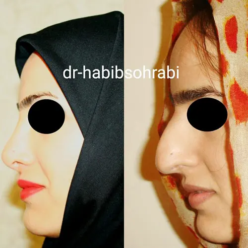 عکس قبل و بعد عمل بینی استخوانی