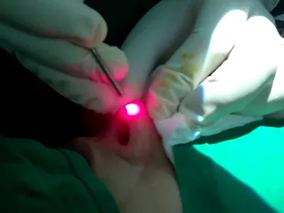 جراحی زیبایی بینی با لیزر