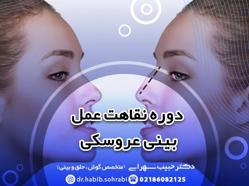 دوره نقاهت عمل بینی عروسکی