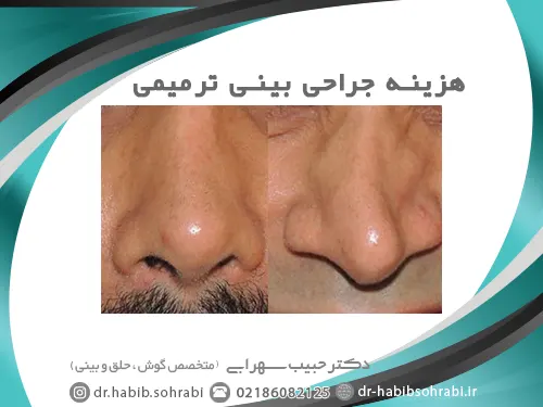 هزینه جراحی بینی ترمیمی