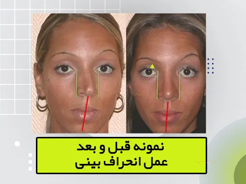 عکس قبل و بعد زیباجوی عمل بینی انحرافی