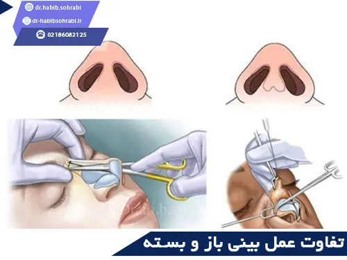 انواع جراحی بینی(عمل بینی به روش باز و بسته)
