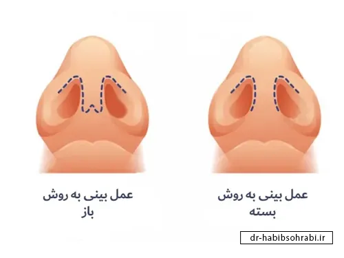 انواع جراحی بینی(تفاوت عمل بینی باز و بسته)