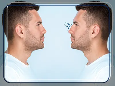 استاندارد بینی مردانه طبیعی زیبا(بینی استخوانی مردانه)