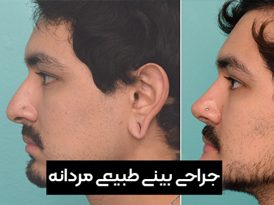 جراحی بینی طبیعی مردانه در تهران