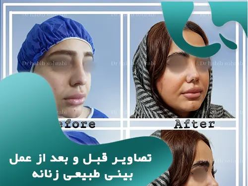 تصاویر قبل و بعد از عمل بینی طبیعی زنانه