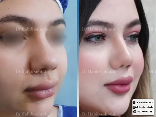 عکس قبل و بعد عمل بینی دکتر حبیب سهرابی
