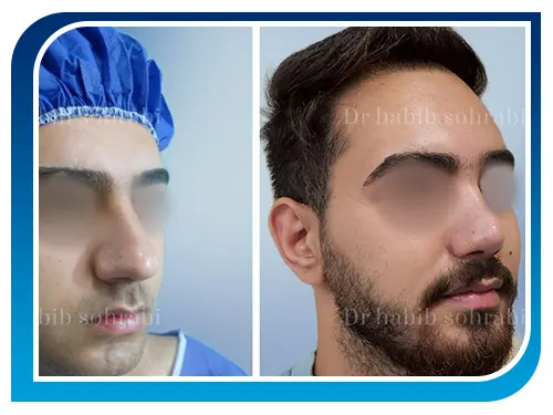 عکس قبل و بعد از عمل بینی طبیعی مردانه