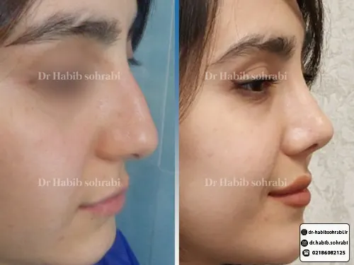 عکس قبل و بعد عمل بینی دکتر حبیب سهرابی
