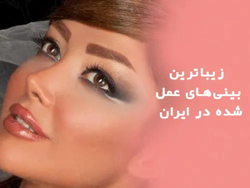 زیباترین بینیهای عمل شده در ایران
