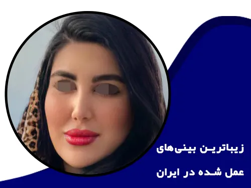 زیباترین بینیهای عمل شده در ایران