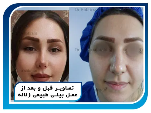 تصاویر قبل و بعد از عمل بینی طبیعی زنانه