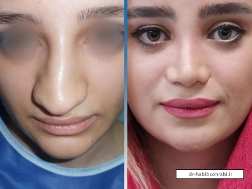 فرم اصلی بینی بعد از عمل(6 ماه بعد)