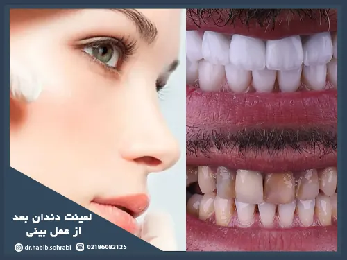 دندانپزشکی بعد از عمل بینی(لمینت)