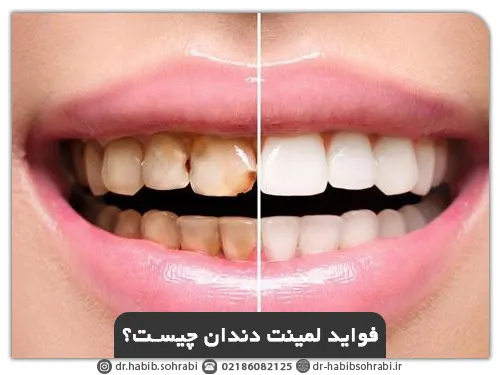 انجام لمینت دندان در وقت مناسب چه خوبی‌هایی دارد؟