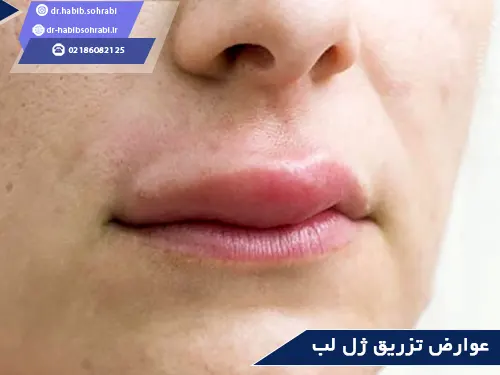 عوارض تزریق ژل لب بعد از عمل بینی