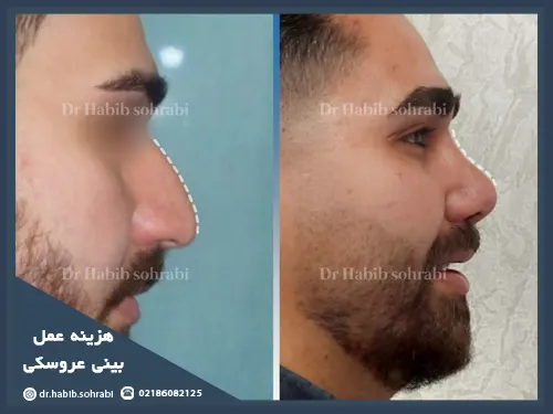 هزینه عمل بینی عروسکی