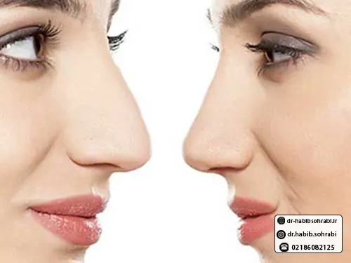 بهترین جراح بینی استخوانی(مشخصات بینی گوشتی)