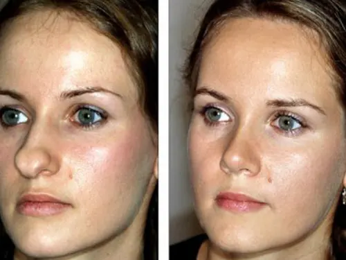 تصاویر بینی نوک گرد(قبل و بعد از عمل)