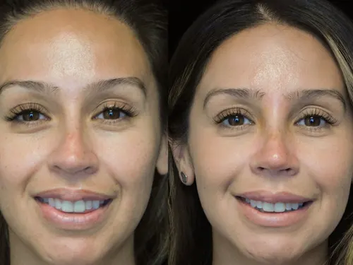تصاویر بینی نوک گرد(قبل و بعد از عمل)