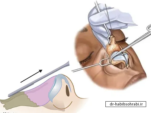تفاوت جراحی استئوتومی و رسپینگ(سوهان کشیدن بینی)