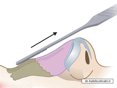 نحوه خروج استخوانهای تراشیده بعد از سوهان کشیدن بینی
