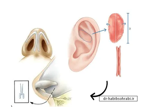 مزایا و معایب غضروف مصنوعی بینی