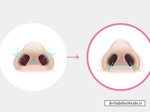 تفاوت رینوپلاستی و آلارپلاستی(کوچک کردن پره های بینی)چیست