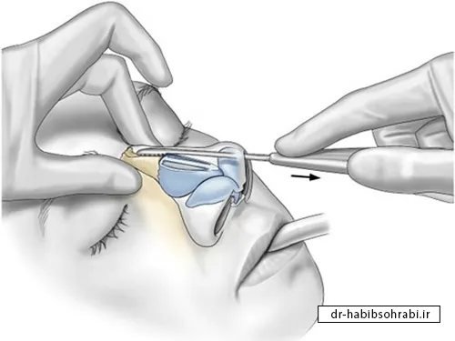 سوهان کشیدن بینی برای رفع دفورمیتی بینی