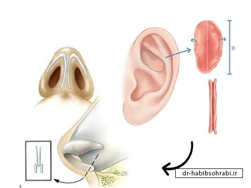 پیوند غضروف برای رفع دفورمیتی بینی