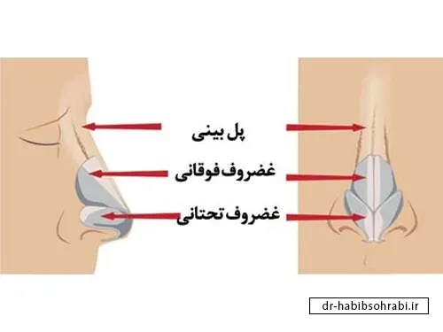 ورم پل بینی بعد از عمل(ساختار بینی)